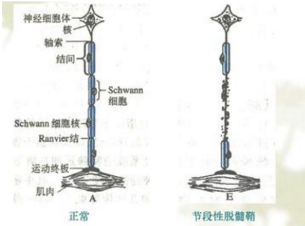 脱髓鞘康复案例分享