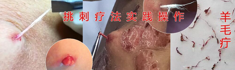 挑刺療法培訓